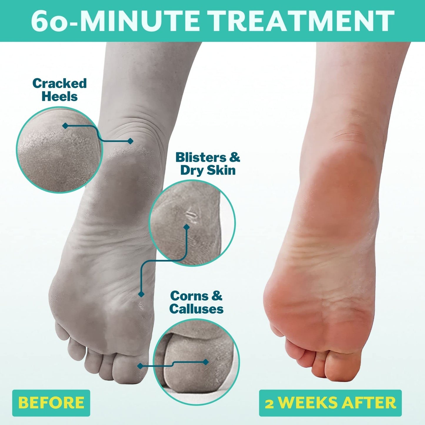 Patchology PoshPeel Pedi Cure - Foot Peeling Mask Soak Treatment, Feet masks for dry cracked feet, Pedicure Booties w/Deep Exfoliation for Baby-soft Skin, Pedi Supplies for Foot Care, 1 Pair