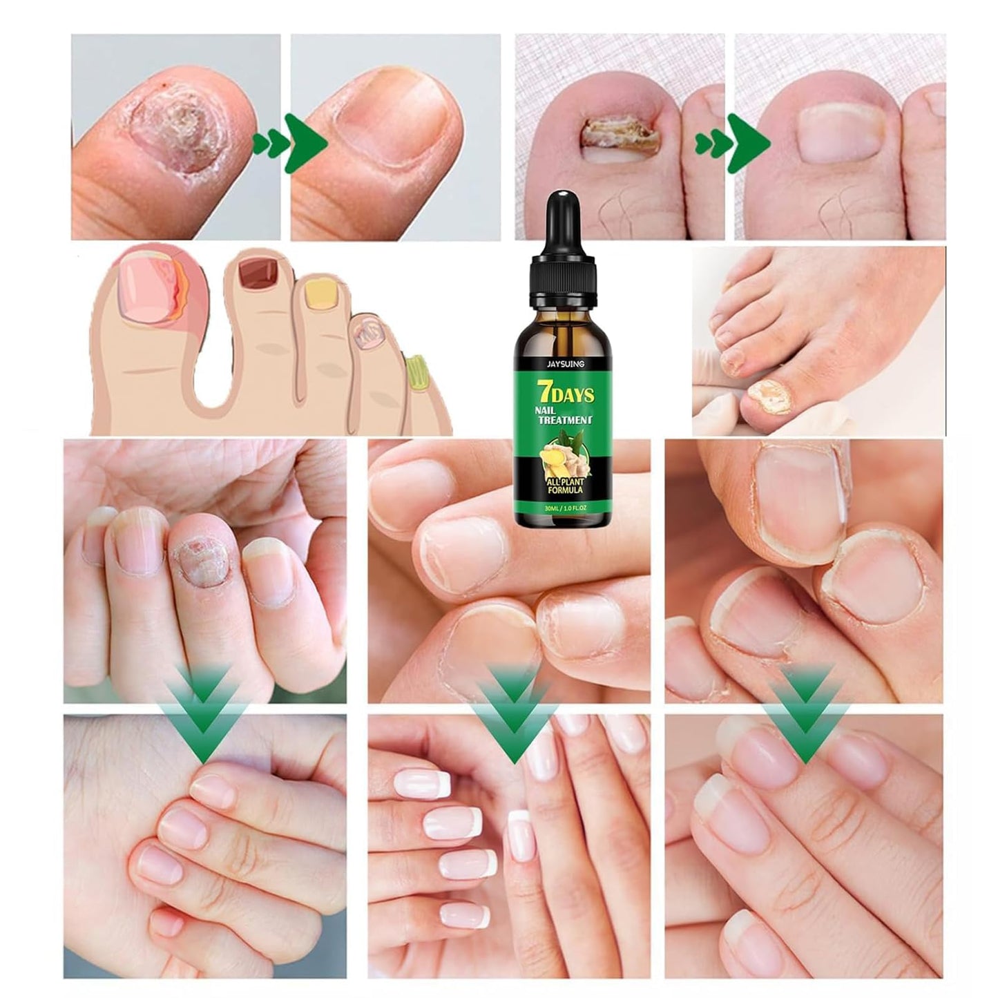 7days Nail Treatment, Ginger Nail Treatment,Nail Support Nail Care,Ginger Nail Growth Serum, Ginger Cuticle Care Oil for Nails (3PCS)