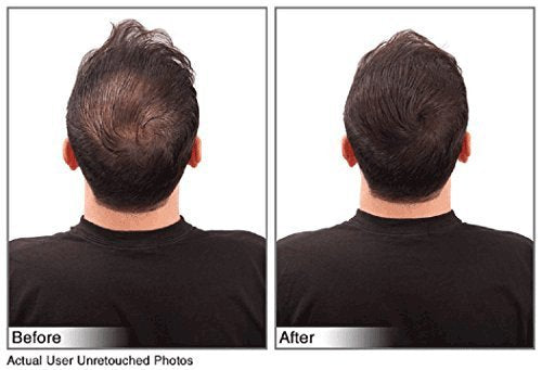 Hair Building Fibers Instantly Conceal Thinning Hair and Bald Spots for Men & Women (Large 28 Grams Bottle) - Undetectable, Washes Away, For All Hair Types, No Animal Byproducts (Medium Brown)
