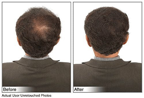 Hair Building Fibers Instantly Conceal Thinning Hair and Bald Spots for Men & Women (Large 28 Grams Bottle) - Undetectable, Washes Away, For All Hair Types, No Animal Byproducts (Medium Brown)