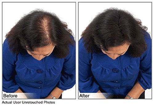 Hair Building Fibers Instantly Conceal Thinning Hair and Bald Spots for Men & Women (Large 28 Grams Bottle) - Undetectable, Washes Away, For All Hair Types, No Animal Byproducts (Medium Brown)