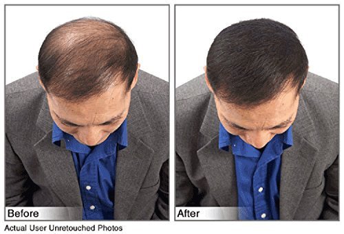 Hair Building Fibers Instantly Conceal Thinning Hair and Bald Spots for Men & Women (Large 28 Grams Bottle) - Undetectable, Washes Away, For All Hair Types, No Animal Byproducts (Medium Brown)