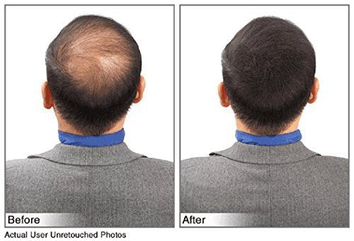 Hair Building Fibers Instantly Conceal Thinning Hair and Bald Spots for Men & Women (Large 28 Grams Bottle) - Undetectable, Washes Away, For All Hair Types, No Animal Byproducts (Medium Brown)