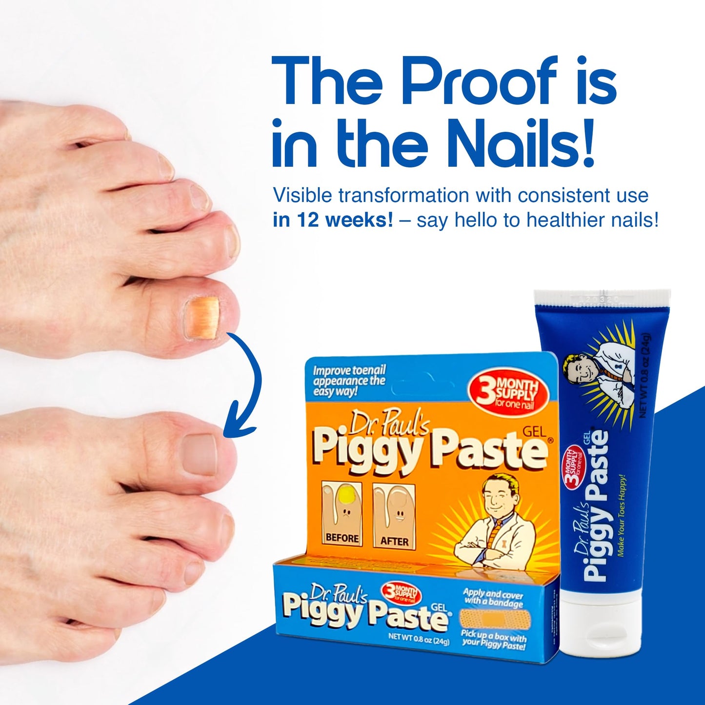 Dr. Paul's Piggy Paste Gel: Fast Acting Solution for Thick, Brittle, Yellow Nails, Restores Clear, Healthy Toenails & Fingernails, Easy, Mess Free Application Doctor Recommended Formula