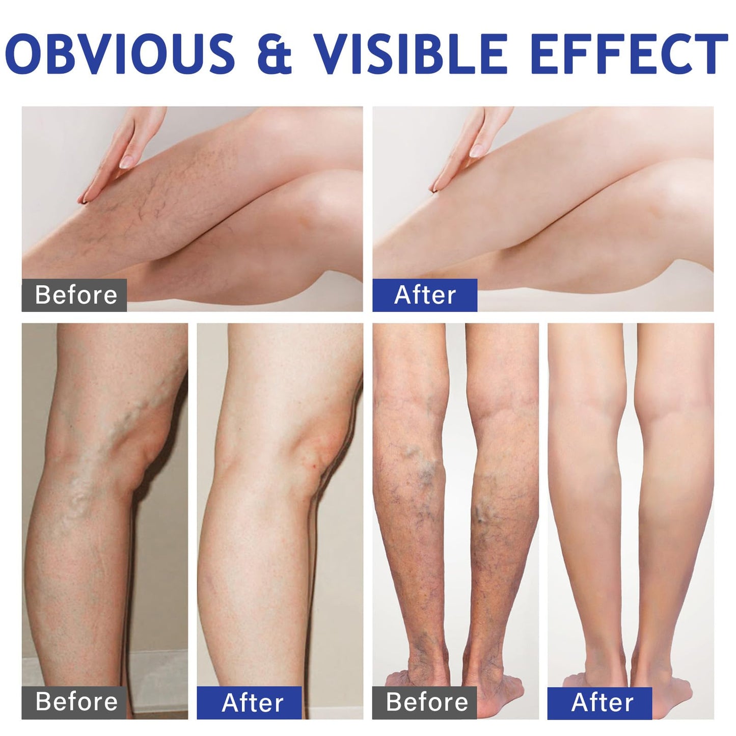 Varicose Veins Treatment for Legs, 20 PCS Effective & Natural Varicose Veins Treatment Patches Soothe Varicose & Spider Veins, Varicose Veins Treatment for Legs Swollen & Restless