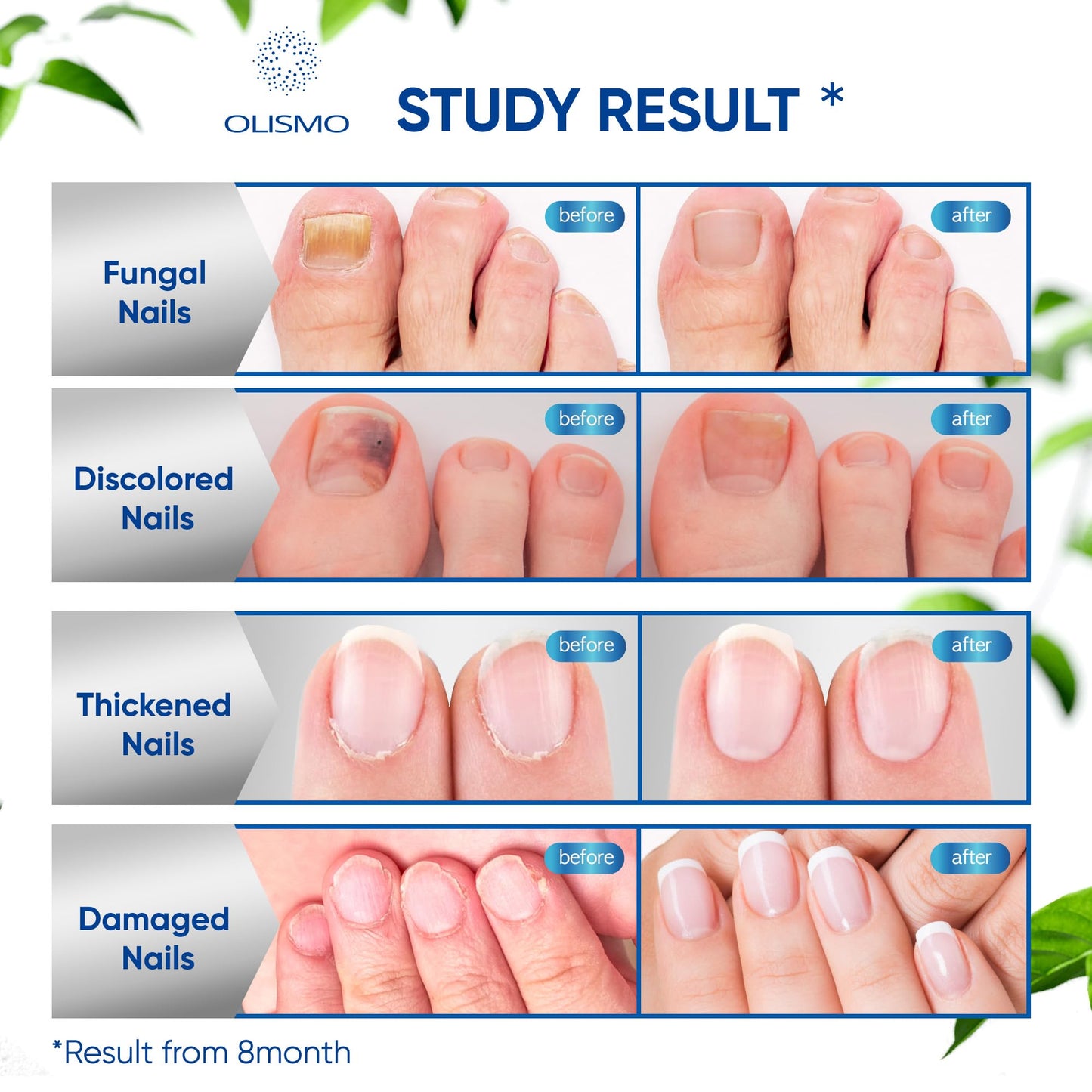 Toenail Fungus Treatment, Nail Fungus Treatment for Toenail, Toe Nail Fungus Treatment Extra Strength for Woman and Man, Nail Fungus Treatment 30ML (1 FLOZ)
