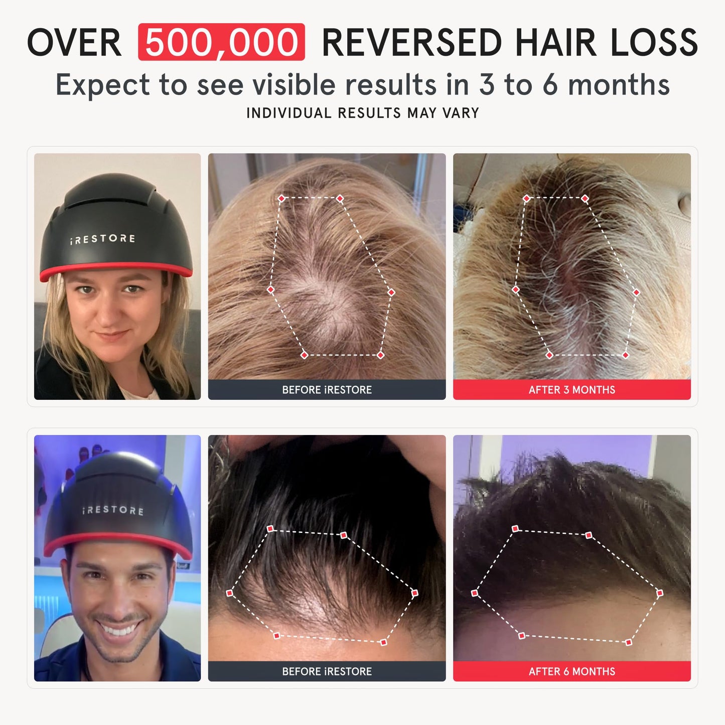 iRestore Elite + Rechargeable Battery Pack - Laser Red Light Therapy for Hair Growth - FDA Cleared Hair Loss, Hair Thinning Treatment for Men & Women - Hair Regrowth Laser Cap - 500 Lasers & LEDs