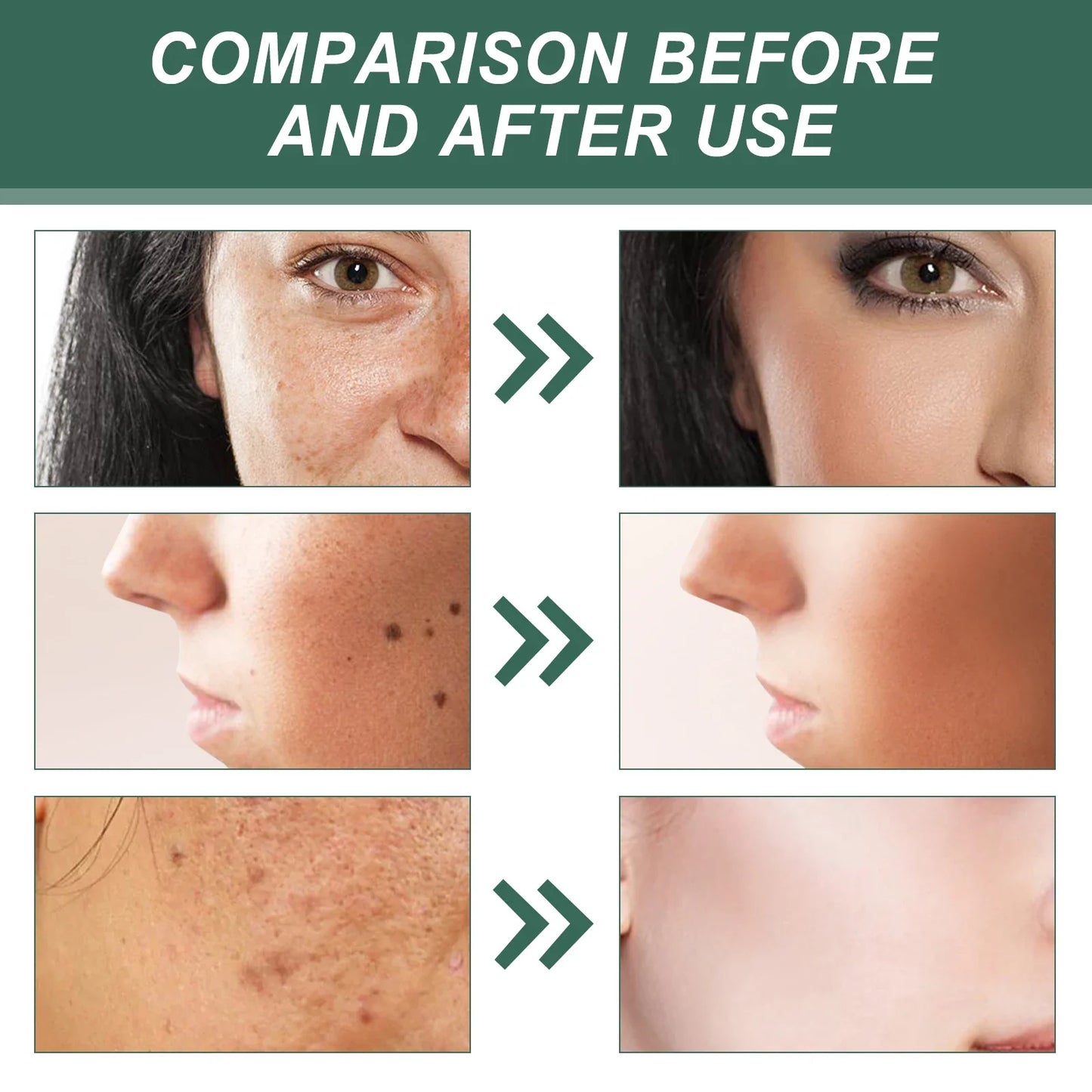 EELHOE Face Spot Remover Cream Moisturizing Brightening Skin Melasma Lightening Acne Marks Treatment Soothing Facial Skin Care