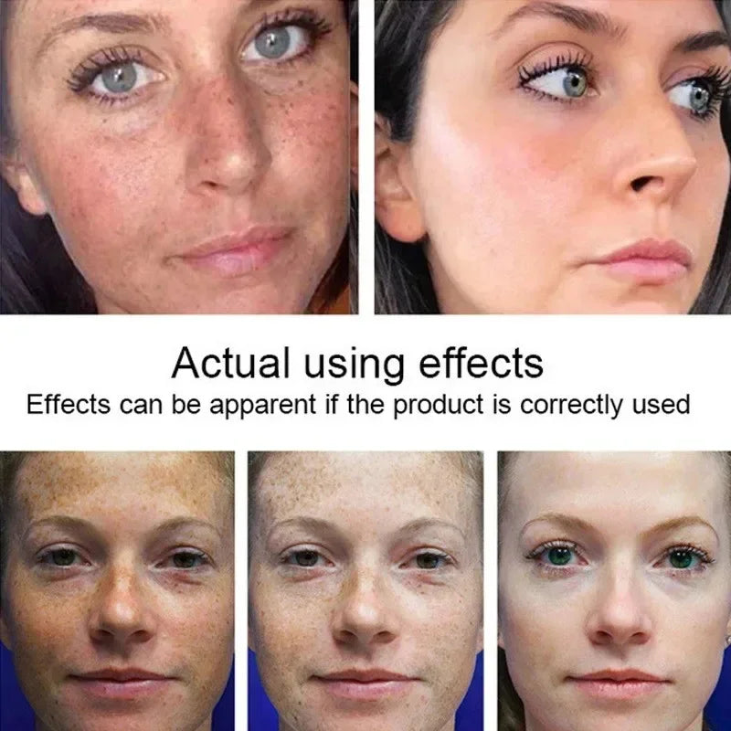 Vitamin C Whitening Freckles Serum Cream Remove Dark Spots Fade Melasma Lighten Melanin Pigment Bleaching Moisturizing Skin Care