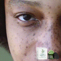 EELHOE Face Spot Remover Cream Moisturizing Brightening Skin Melasma Lightening Acne Marks Treatment Soothing Facial Skin Care