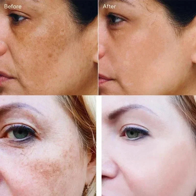 Vitamin C Whitening Freckles Serum Cream Remove Dark Spots Fade Melasma Lighten Melanin Pigment Bleaching Moisturizing Skin Care