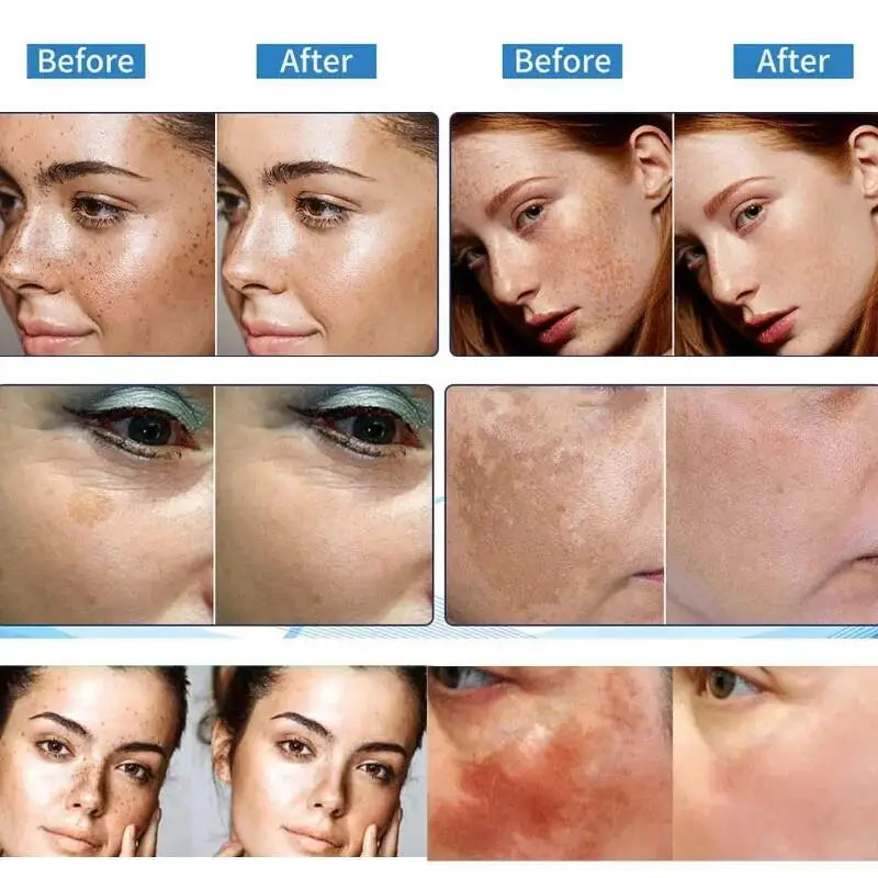Powerful Spot-removing Whiten Cream Brighten Skin Fast Eliminates Melanin Pigmentation Melasma Dark Spots Moisturize Beauty Gel
